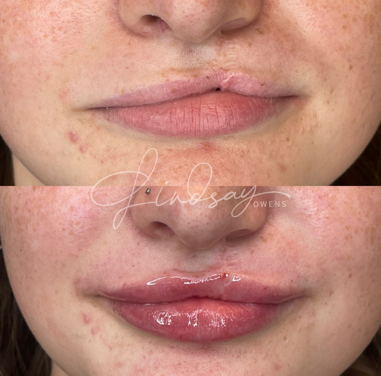 Cleft lip filler result showing improved symmetry and contour