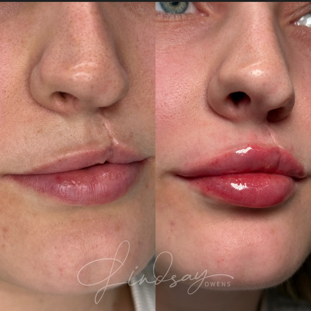 Natural, balanced lip result