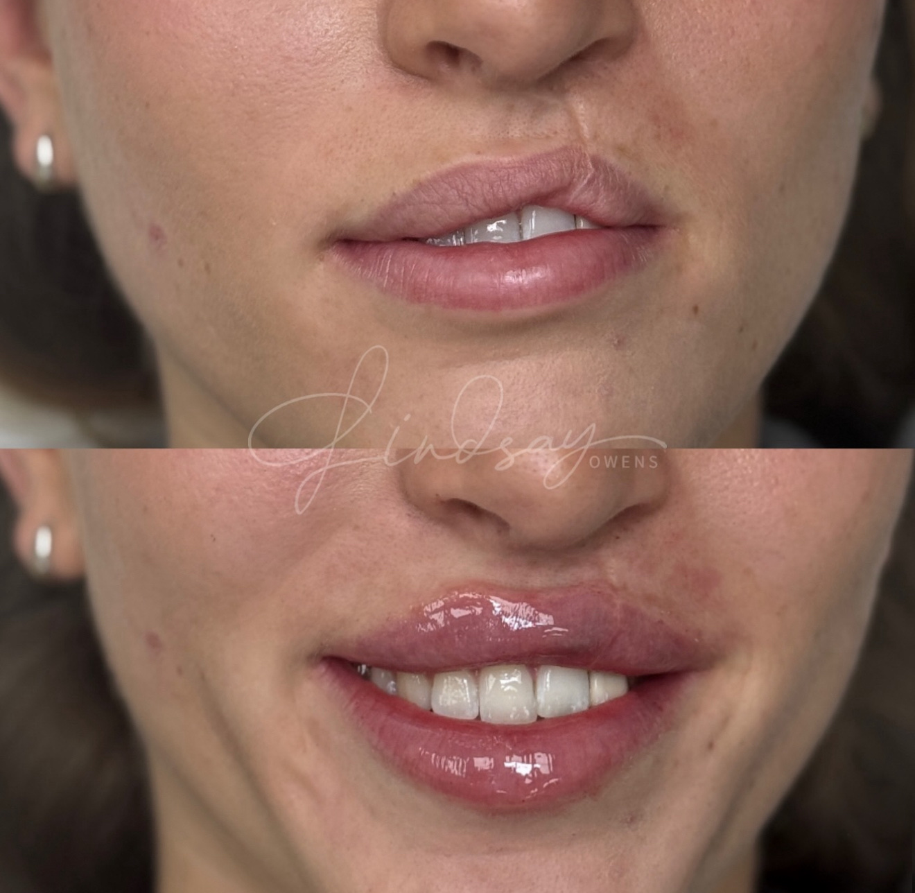 Improved lip symmetry after filler