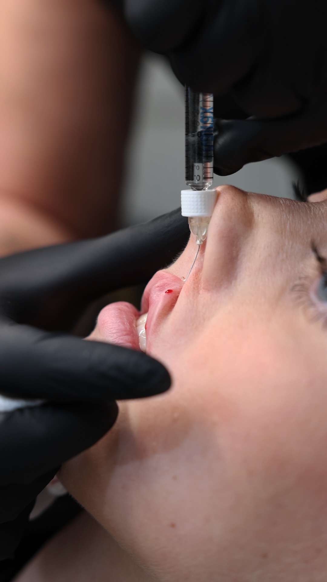 Unilateral cleft lip result
